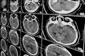 Traumatic Brain Injury Statistics